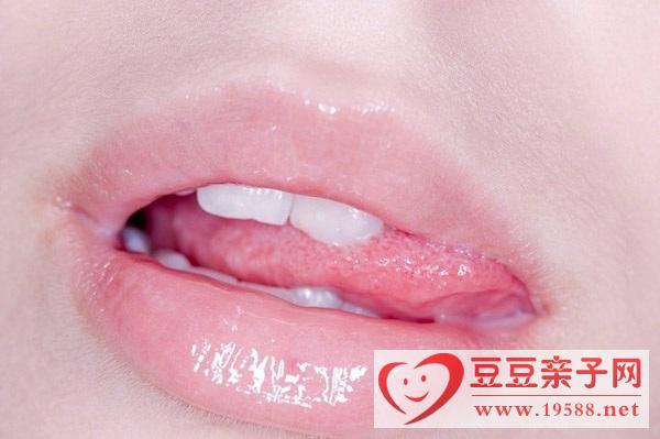 烂嘴角的原因？如何预防烂嘴角？烂嘴角的护理方法