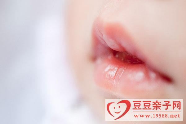 预防宝宝“烂嘴角”，宝宝为啥会患口角炎？